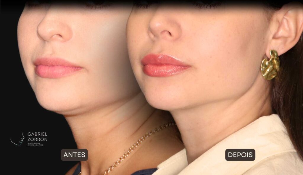 Foto de antes e depois de rinoplastia feminina e natural, realizada pelo especialista Dr Gabriel Zorron - otorrino e cirurgião crânio-maxilo-facial e plástica da face.