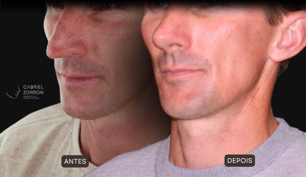 Foto de antes e depois de rinoplastia masculina e natural, realizada pelo especialista Dr Gabriel Zorron - otorrino e cirurgião crânio-maxilo-facial e plástica da face.