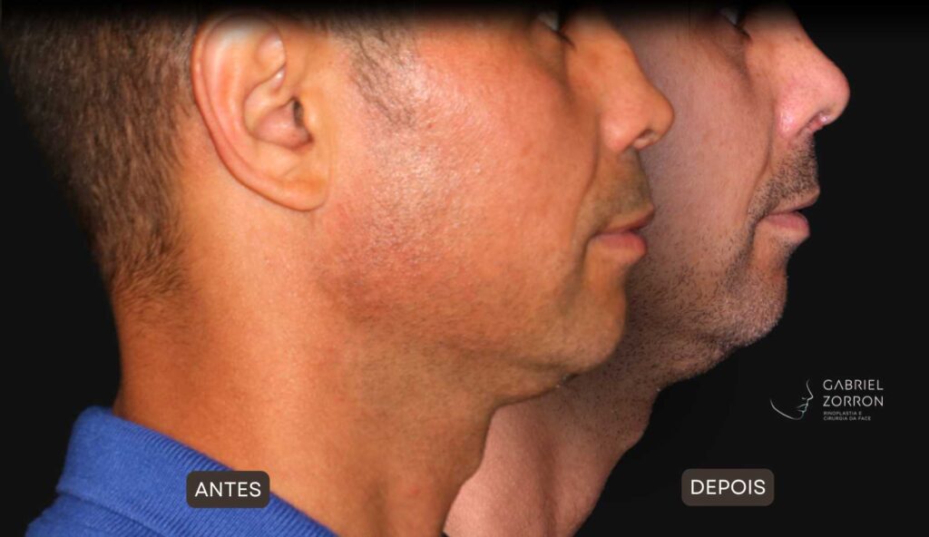 Foto de antes e depois de rinoplastia masculina e natural, realizada pelo especialista Dr Gabriel Zorron - otorrino e cirurgião crânio-maxilo-facial e plástica da face.