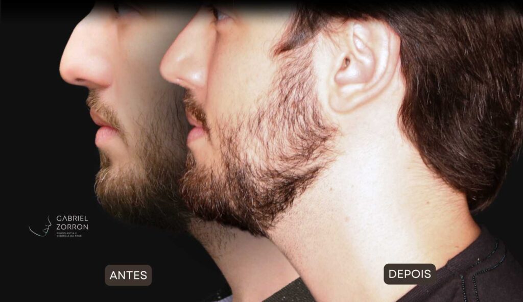 Foto de antes e depois de rinoplastia masculina e natural, realizada pelo especialista Dr Gabriel Zorron - otorrino e cirurgião crânio-maxilo-facial e plástica da face.