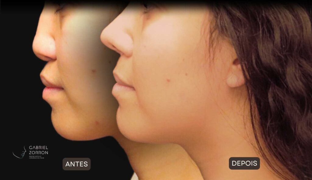 Foto de antes e depois de rinoplastia feminina e natural, realizada pelo especialista Dr Gabriel Zorron - otorrino e cirurgião crânio-maxilo-facial e plástica da face.