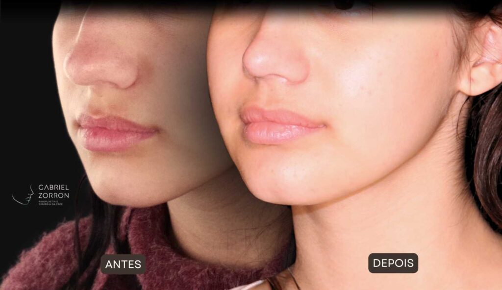 Foto de antes e depois de rinoplastia feminina e natural, realizada pelo especialista Dr Gabriel Zorron - otorrino e cirurgião crânio-maxilo-facial e plástica da face.