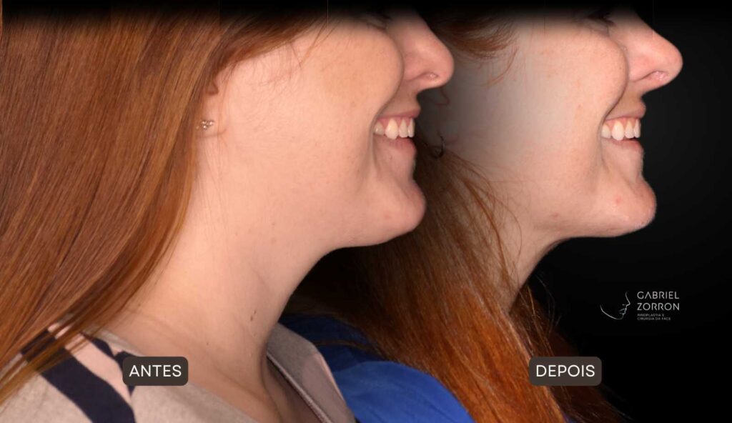 Foto de antes e depois de rinoplastia feminina e natural, realizada pelo especialista Dr Gabriel Zorron - otorrino e cirurgião crânio-maxilo-facial e plástica da face.