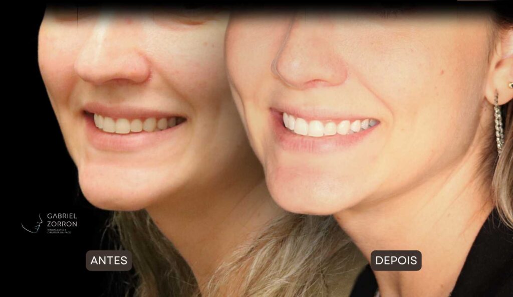 Foto de antes e depois de rinoplastia feminina e natural, realizada pelo especialista Dr Gabriel Zorron - otorrino e cirurgião crânio-maxilo-facial e plástica da face.