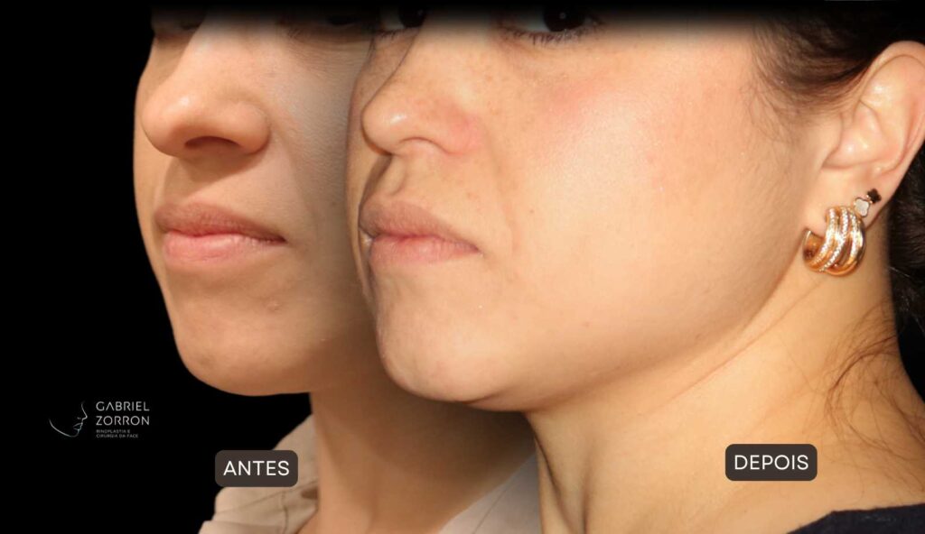 Foto de antes e depois de rinoplastia feminina e natural, realizada pelo especialista Dr Gabriel Zorron - otorrino e cirurgião crânio-maxilo-facial e plástica da face.